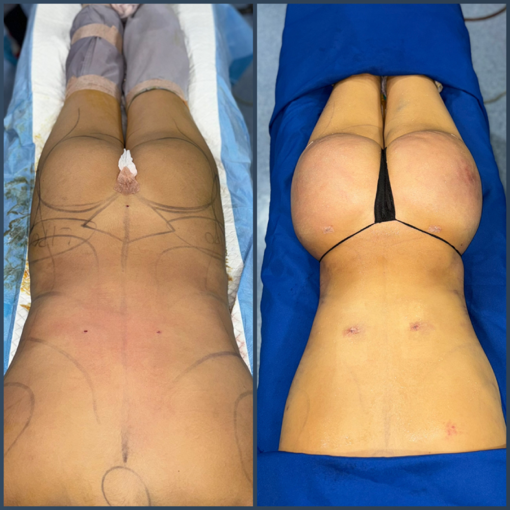 Before after Brazilian Butt Lift in Tijuana