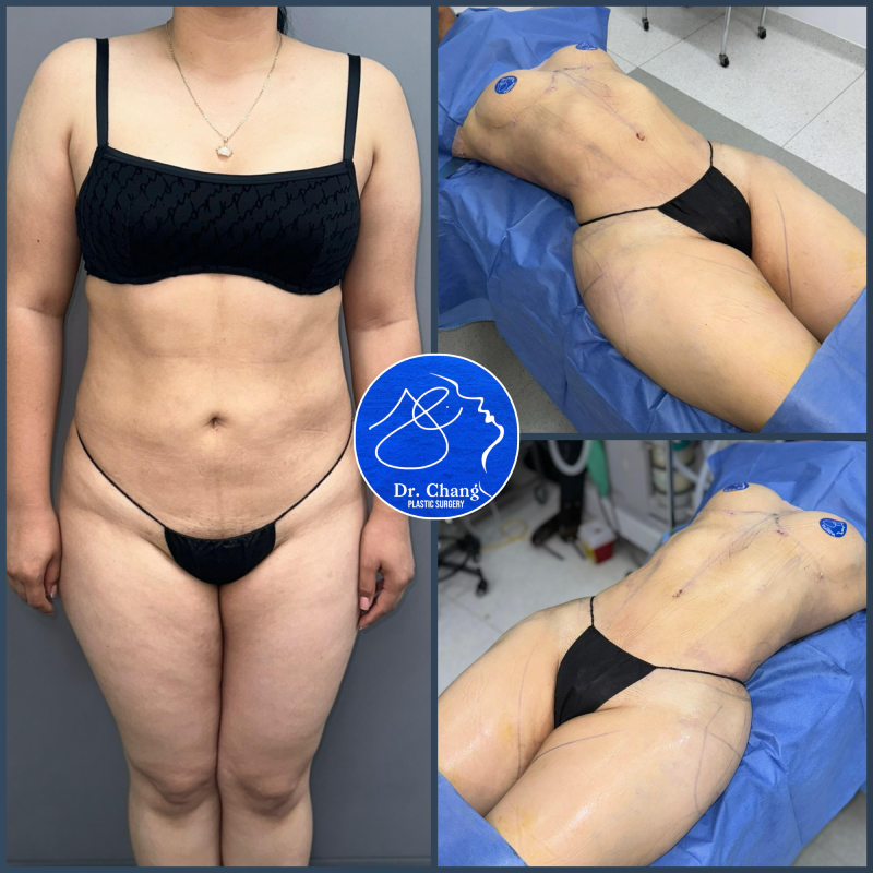 Liposculpture cost Tijuana