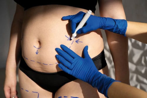 Comparing Mommy Makeover in Tijuana vs USA: Why It Matters