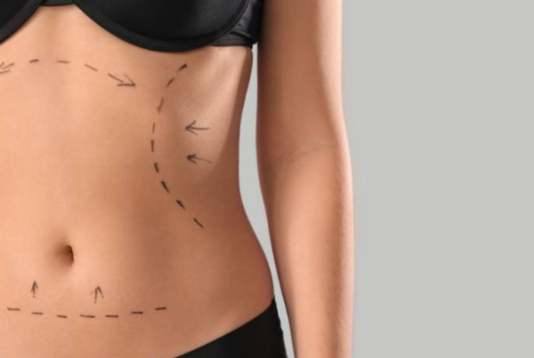 How Long Is Recovery from Mommy Makeover in Tijuana