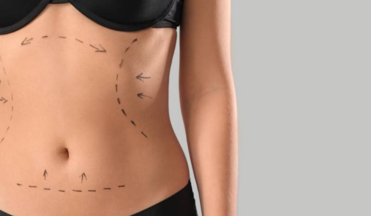 How Long Is Recovery from Mommy Makeover in Tijuana