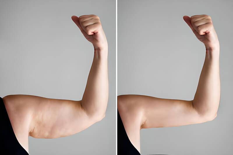 Arm Liposuction Before and After 