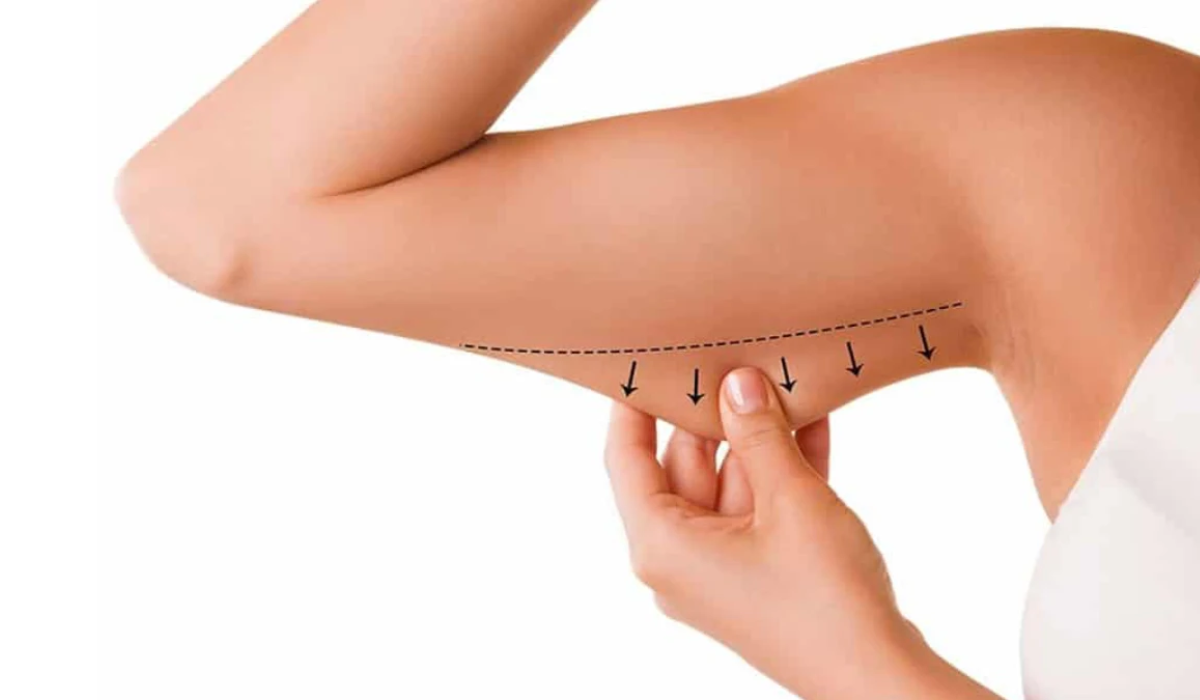 Arm Liposuction in Tijuana: Safe & Affordable Results