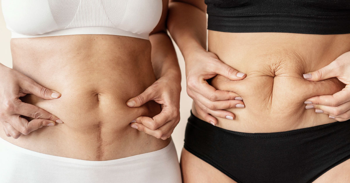 How laser-assisted liposuction works