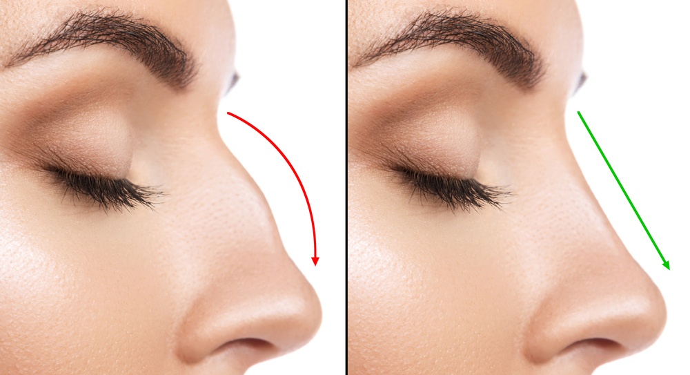 Cosmetic Rhinoplasty with Facial Balance