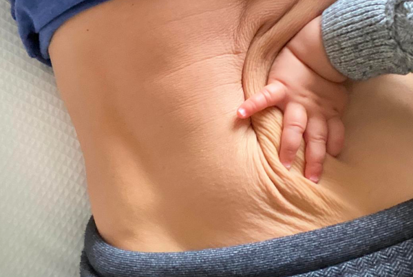 Why do US patients choose a mommy makeover in Tijuana Mexico