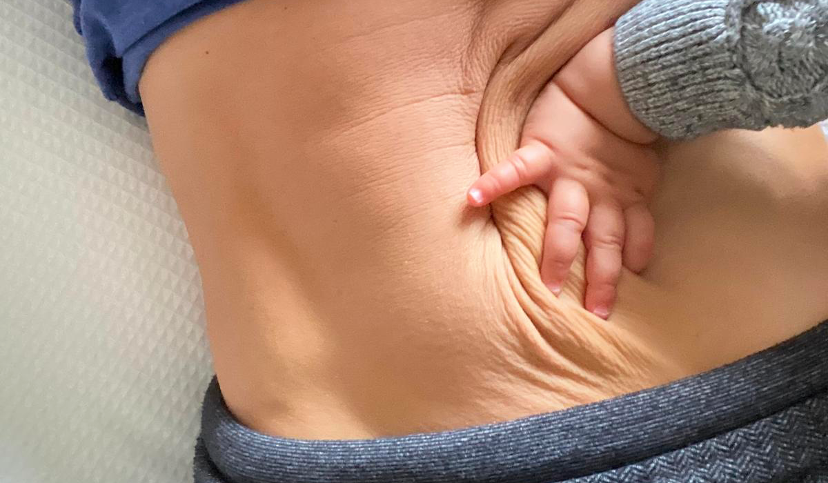 Why do US patients choose a mommy makeover in Tijuana Mexico